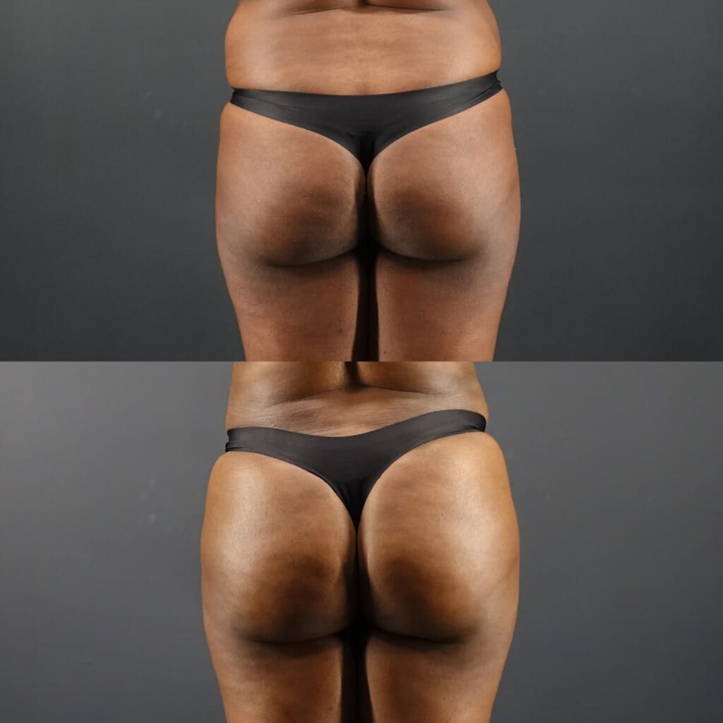 Body liposuction before and after Brazilian Butt Lift, straight rear view of the buttocks and hips built with fat from the abdomen and flanks at 3 months