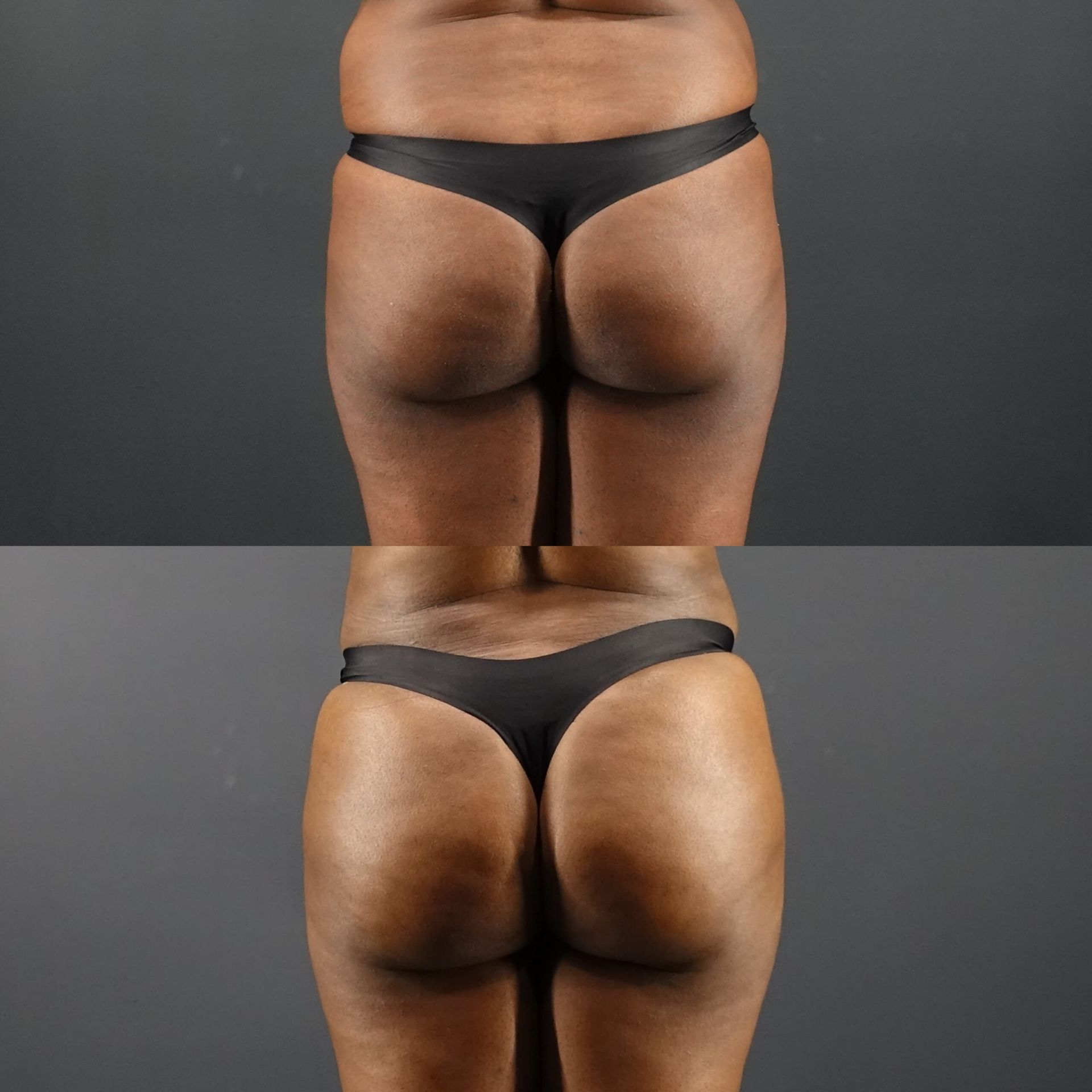 Body liposuction before and after Brazilian Butt Lift, straight rear view of the buttocks and hips built with fat from the abdomen and flanks at 3 months