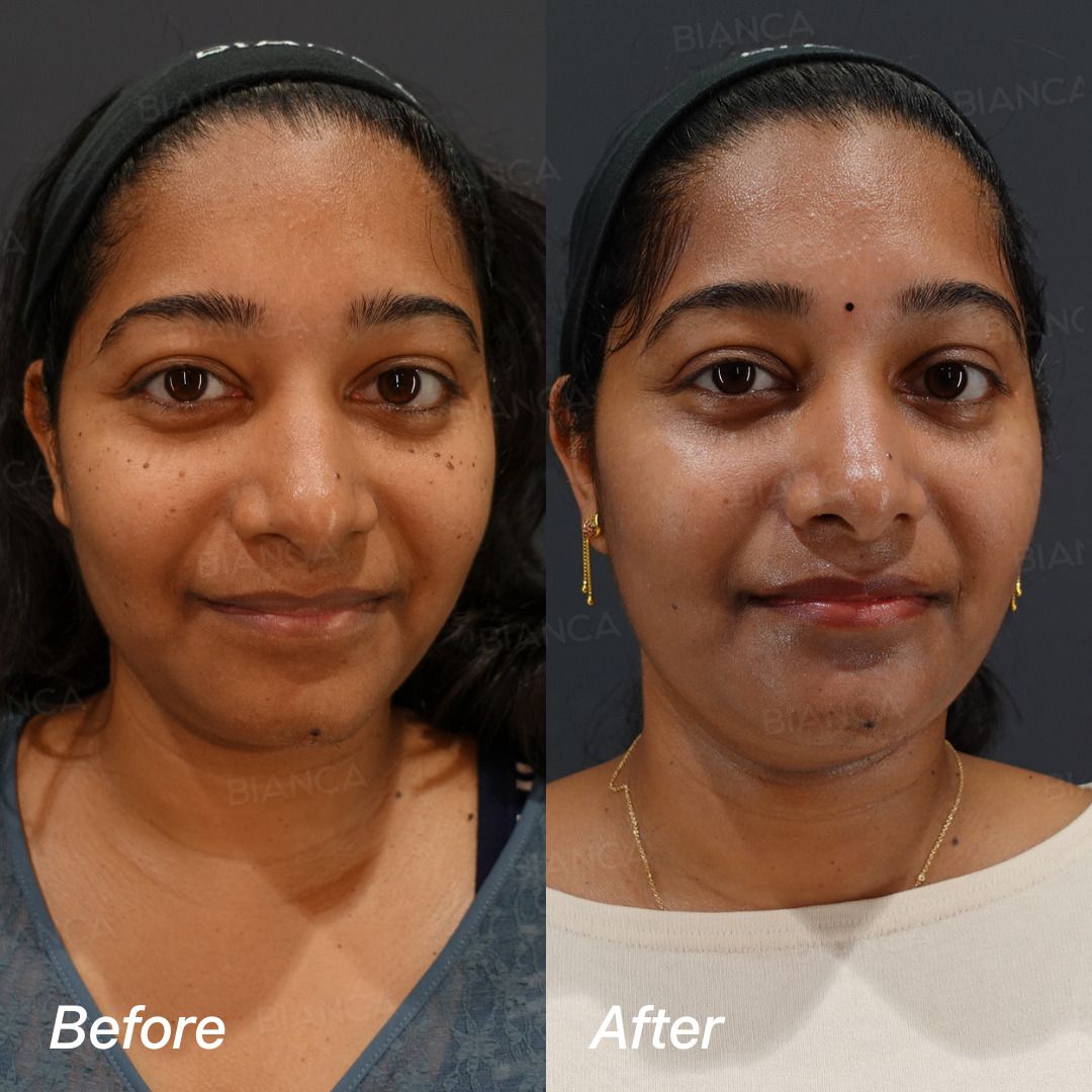 CO2 laser before and after individual removal of moles and warts on the cheek, three-quarter view, at 2 weeks