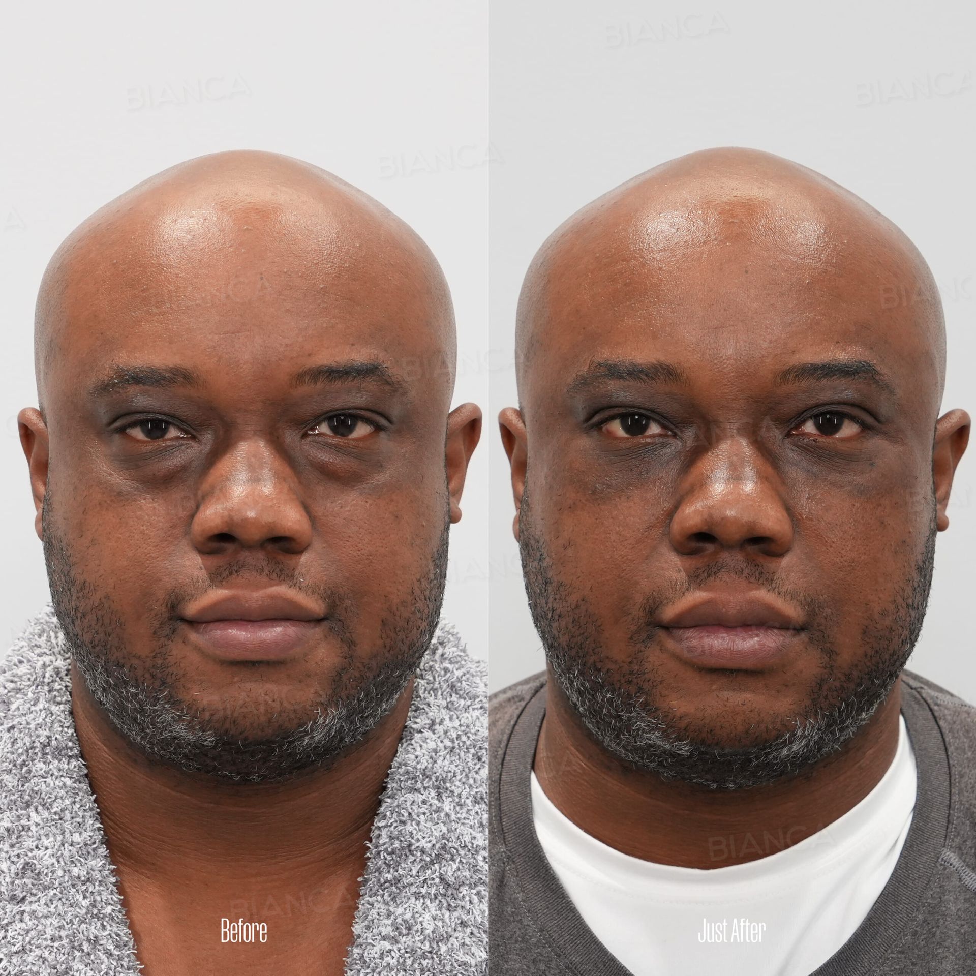 Eye bag removal before and after under eye dark circle and sagging correction with condensed rich fat injection, front view, immediately after treatment