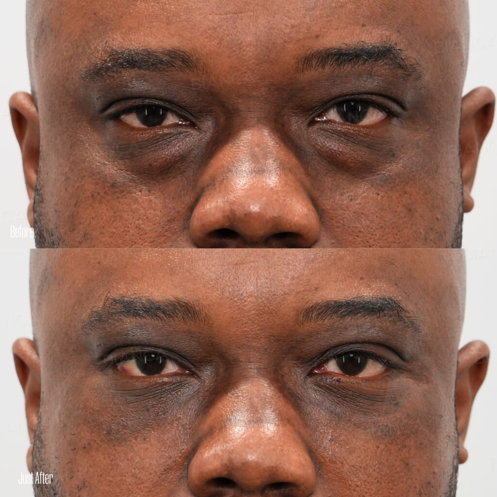 Eye bag removal before and after under eye dark circle and sagging correction with condensed rich fat injection, front view, immediately after treatment