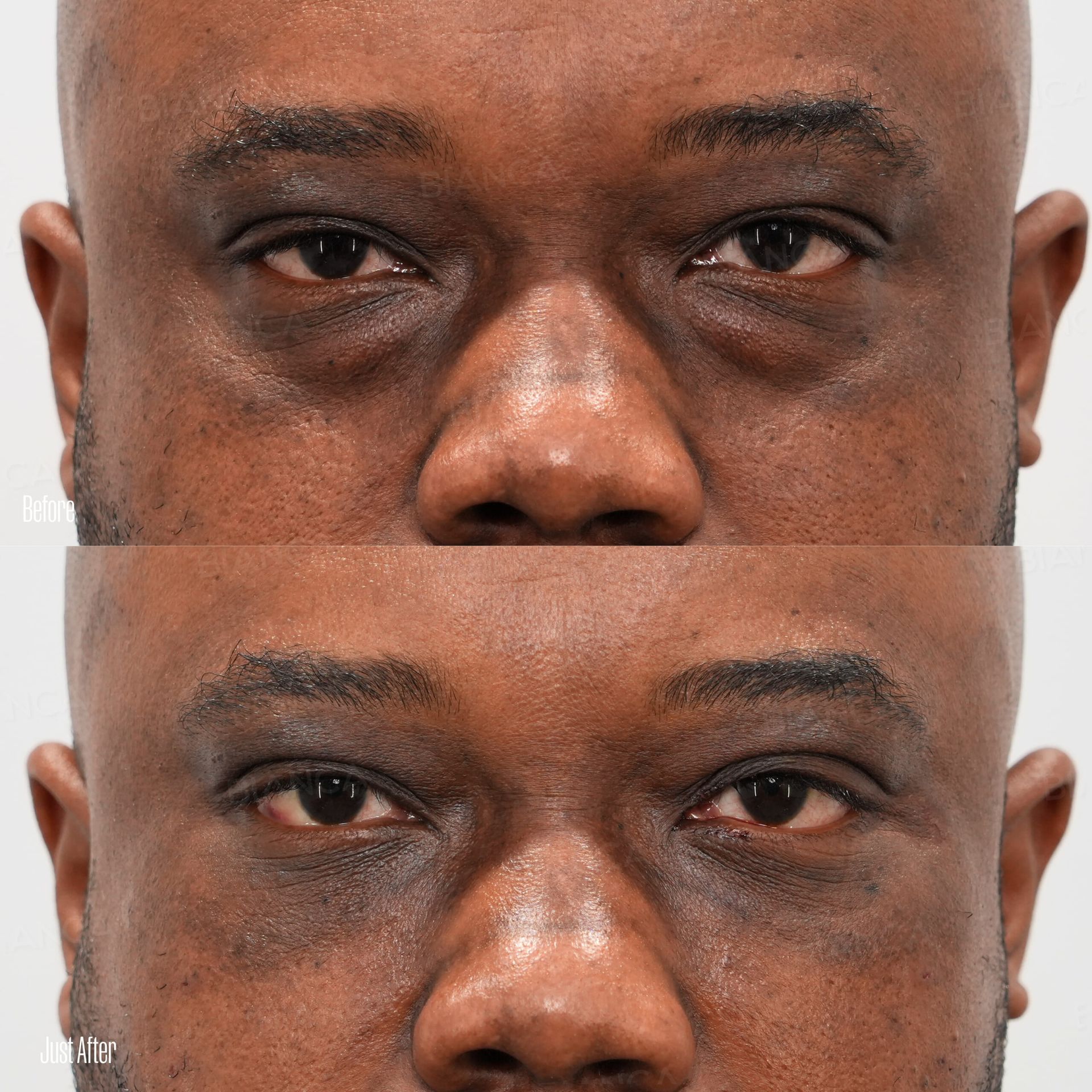 Eye bag removal before and after under eye dark circle and sagging correction with condensed rich fat injection, front view, immediately after treatment
