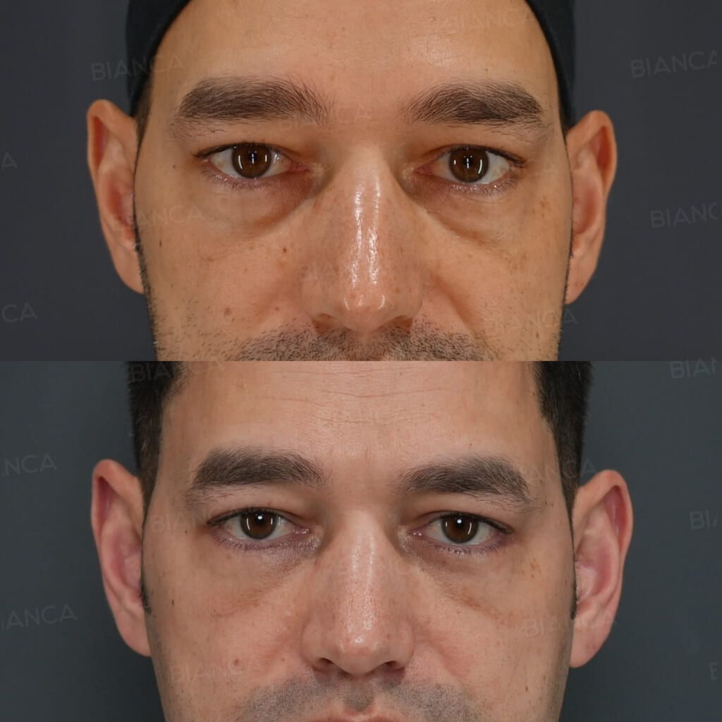 Lower blepharoplasty before and after the Hamra method for dark circles and sagging under the eyes, front view at 1 and 3 months