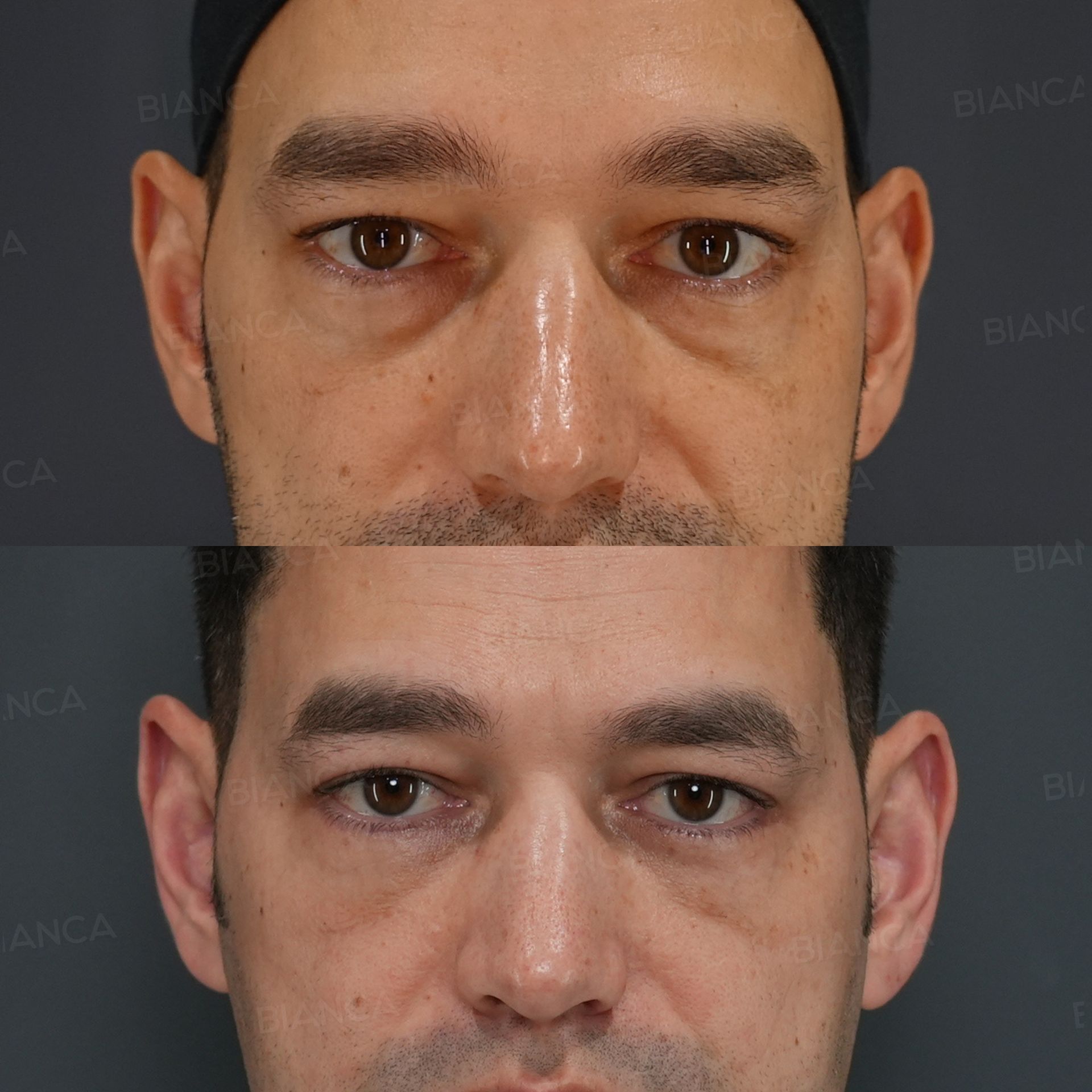 Lower blepharoplasty before and after the Hamra method for dark circles and sagging under the eyes, front view at 1 and 3 months
