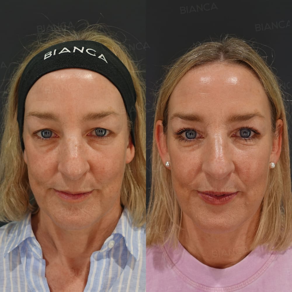 Upper blepharoplasty before and after removal of heavy overhanging upper eyelid skin so the eyes open more easily, front view, at 1 month