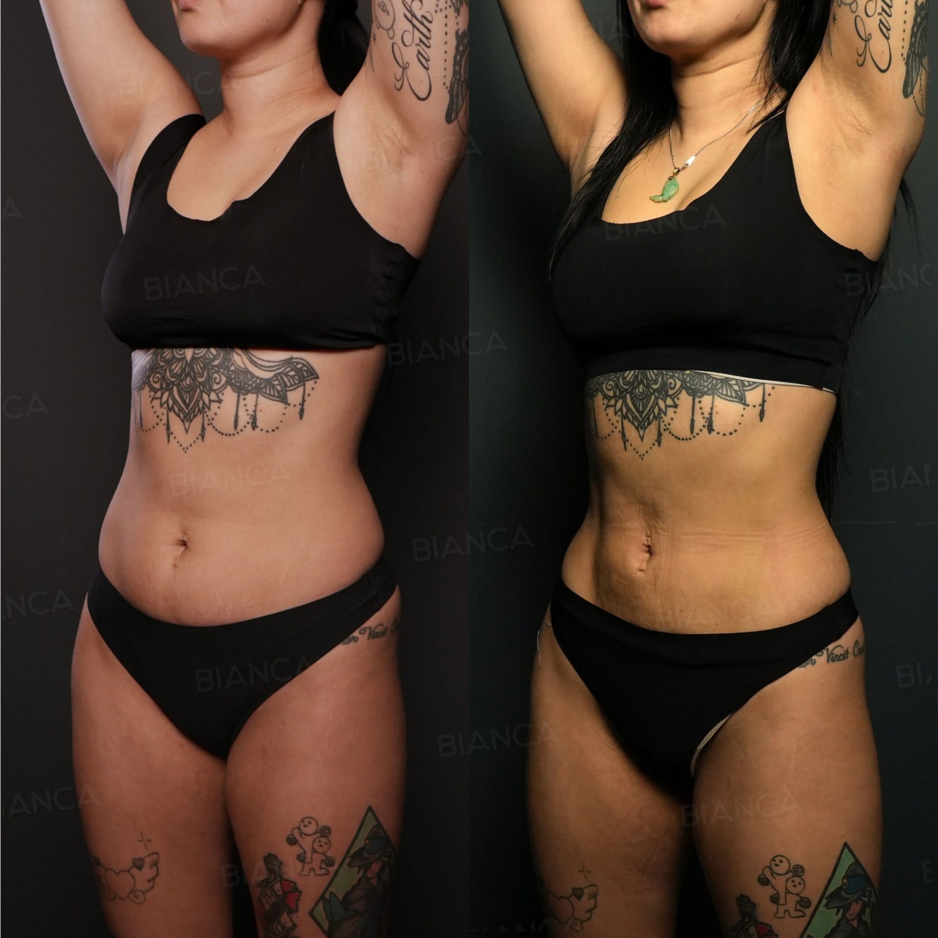 Body liposuction before and after VASER liposuction of the axilla, upper arms, upper and lower abdomen and flanks with Quantum Body radiofrequency at 3 months
