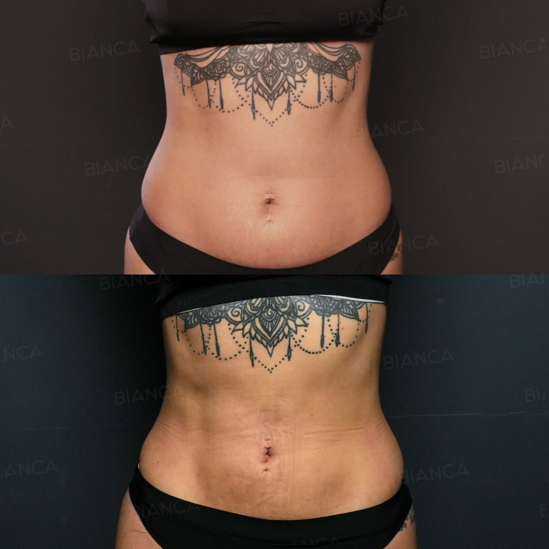 Body liposuction before and after VASER contouring of the axilla, arms, abdomen and flanks with Quantum Body on the lower abdomen at 3 months
