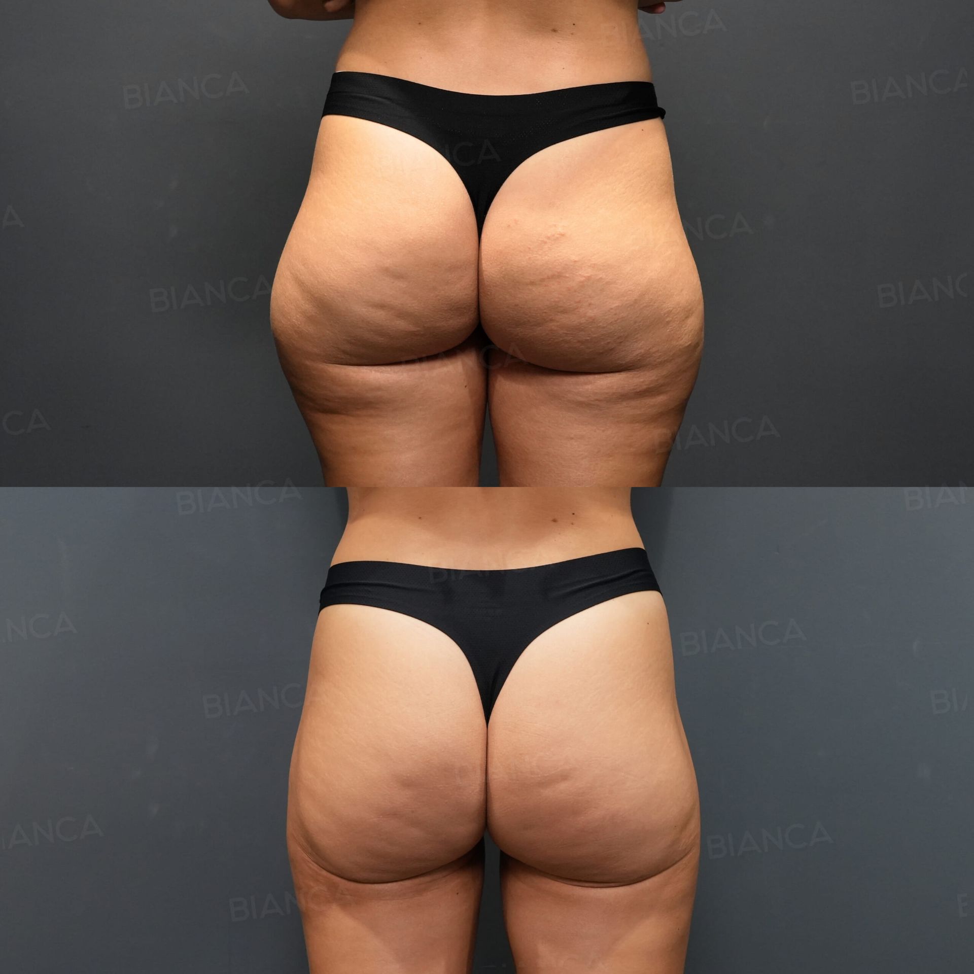Body liposuction before and after VASER of the posterior and outer thighs with Quantum RF Body for skin retraction, rear view at 2 months