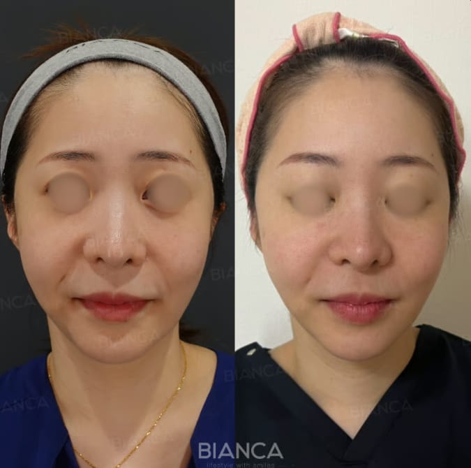BIANCA CLINIC filler treatment, front view before and after comparison