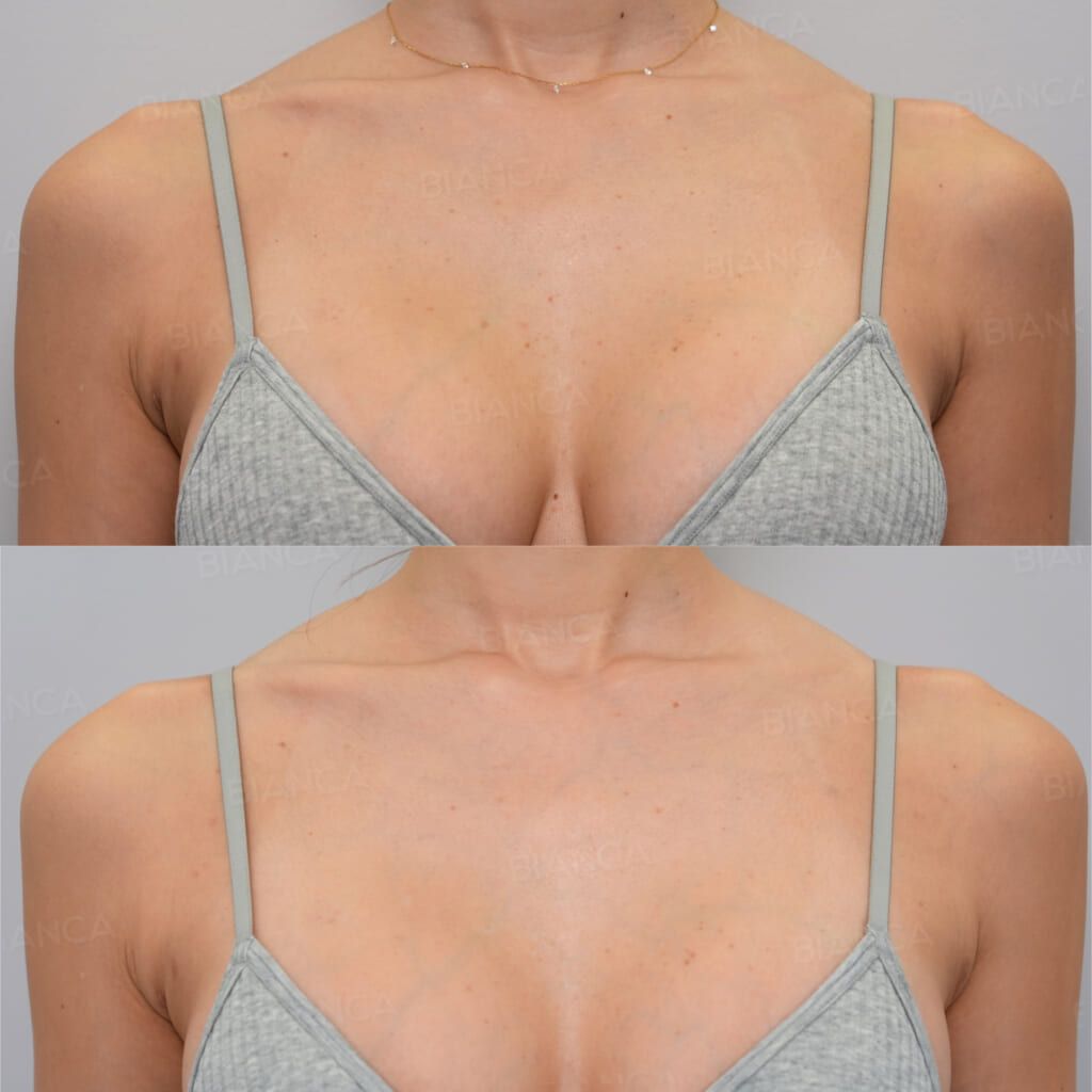 CO2 laser before and after removal of raised warts and pigmented spots across the décolletage at 1 month