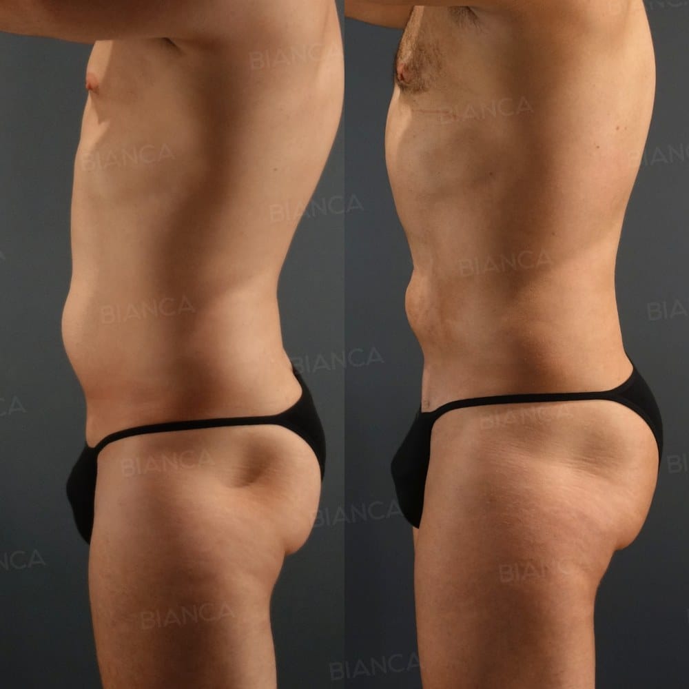 Abcracks + VASER Liposuction (Lower Back) + CRF Brazilian Butt Lift before and after, 1 week, BIANCA CLINIC Tokyo