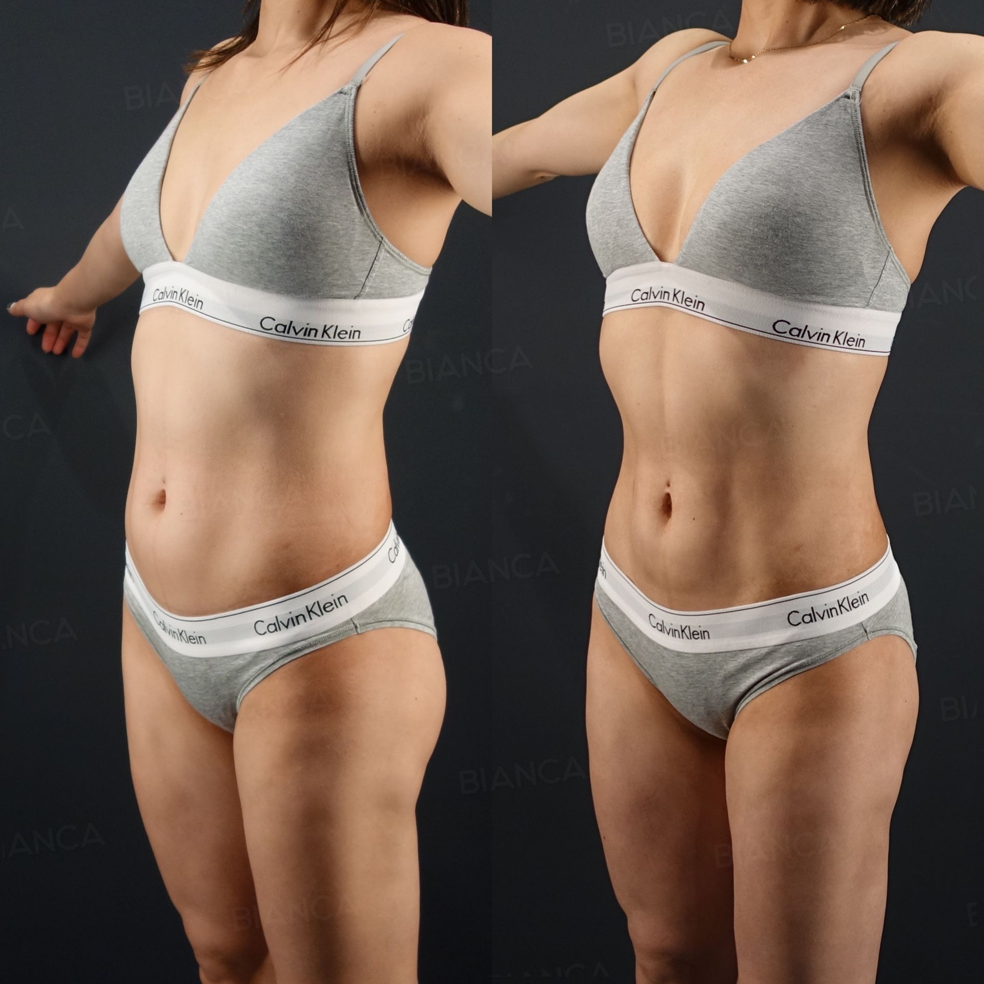 VASER 4D abdominal etching before and after ultrasound assisted liposuction of the abdomen at 6 months