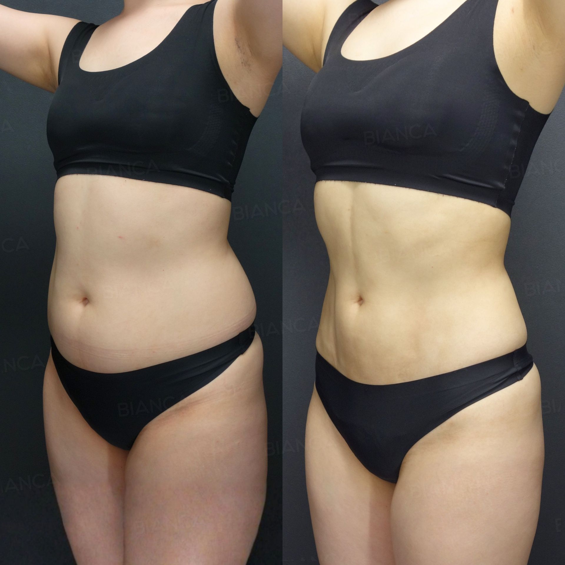 VASER 4D abdominal liposuction before and after abdominal etching along the natural grooves of the abdominal wall at 3 months