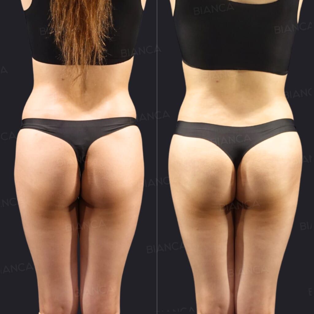 Abdominal VASER Liposuction (Abdominal Etching Technic), Brazilian Butt Lift (BBL)