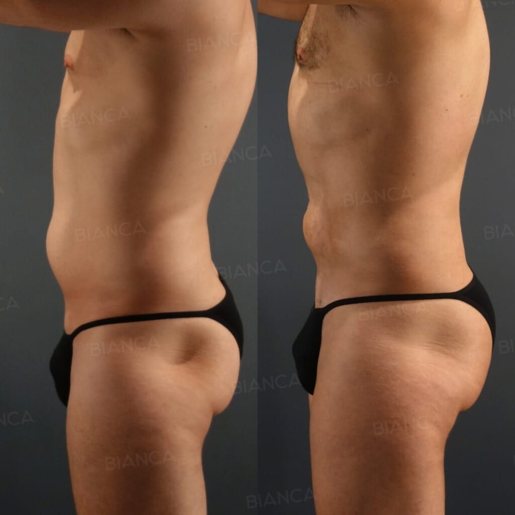 Abdominal VASER Liposuction (Abdominal Etching Technic), VASER Liposuction (Lower Back), Brazilian Butt Lift (BBL)