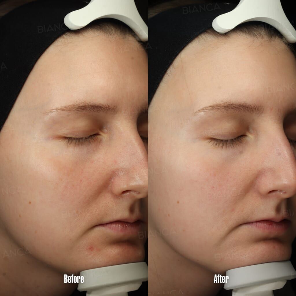 AdvaTx Laser (Full Face, Dual Wavelength)