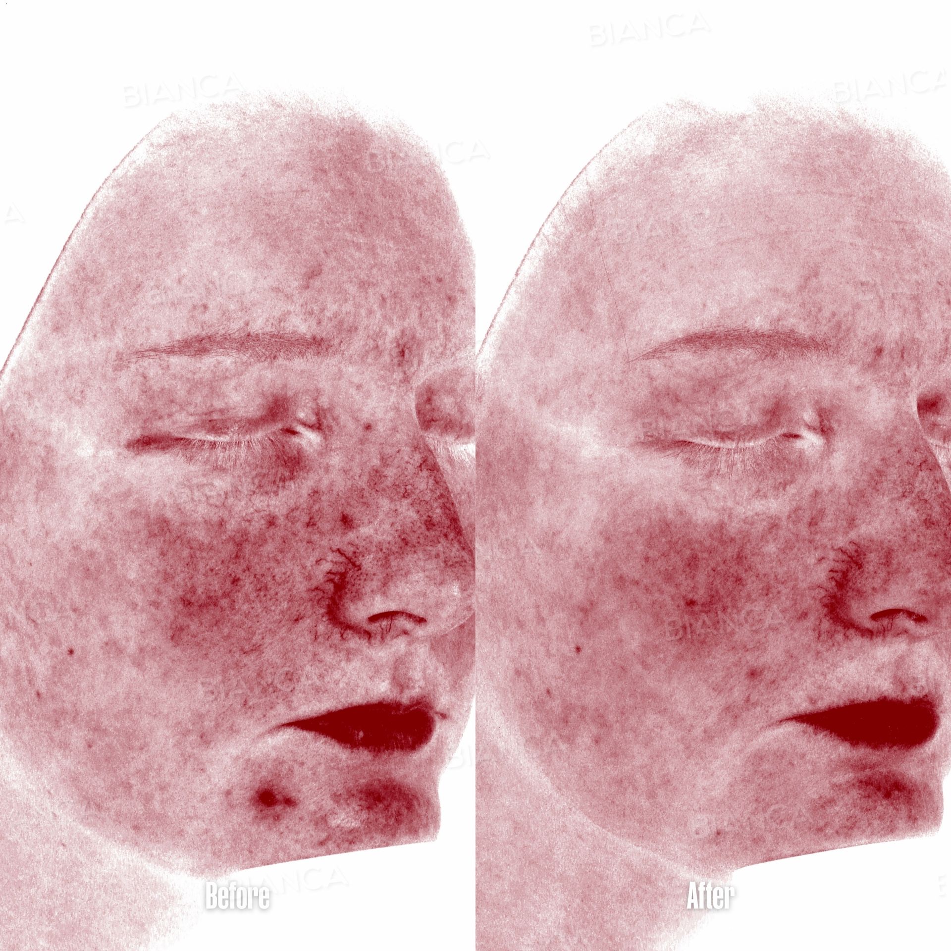 AdvaTx laser before and after full face dual wavelength treatment, red filtered vascular imaging of the face, three-quarter view, at 2 months