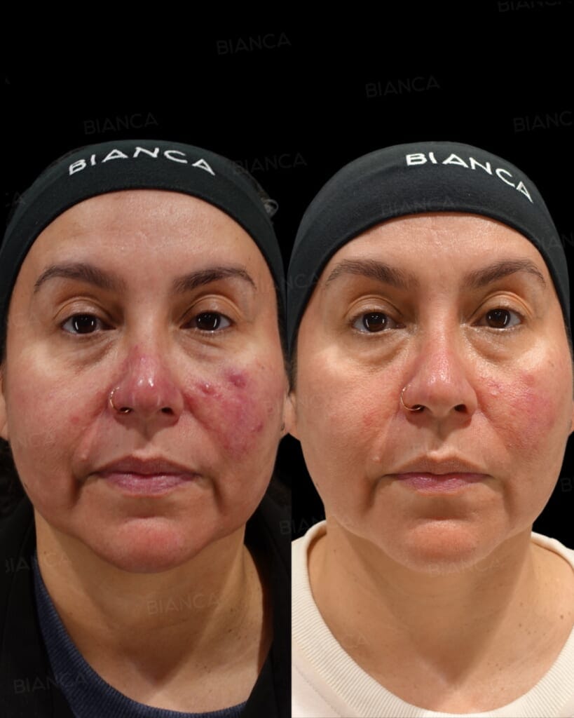 AdvaTx Laser (Full Face, Dual Wavelength)