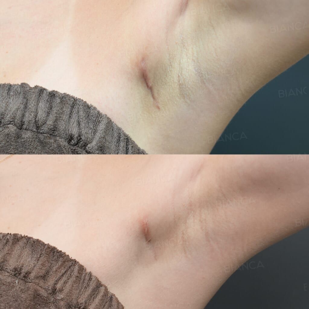 AdvaTx Laser (Scar)