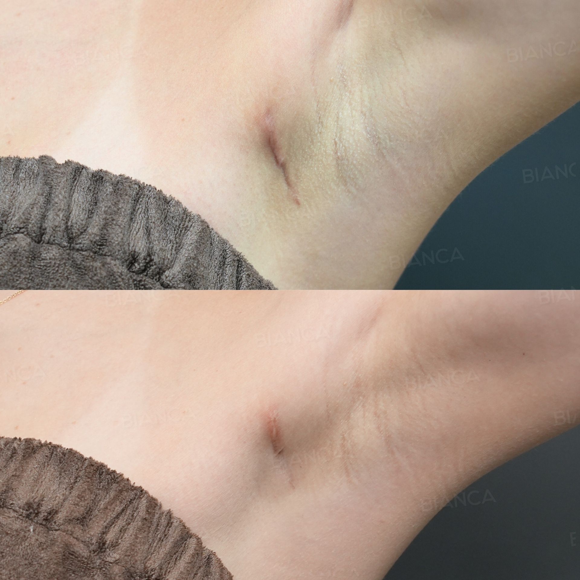 AdvaTx Laser (Scar)