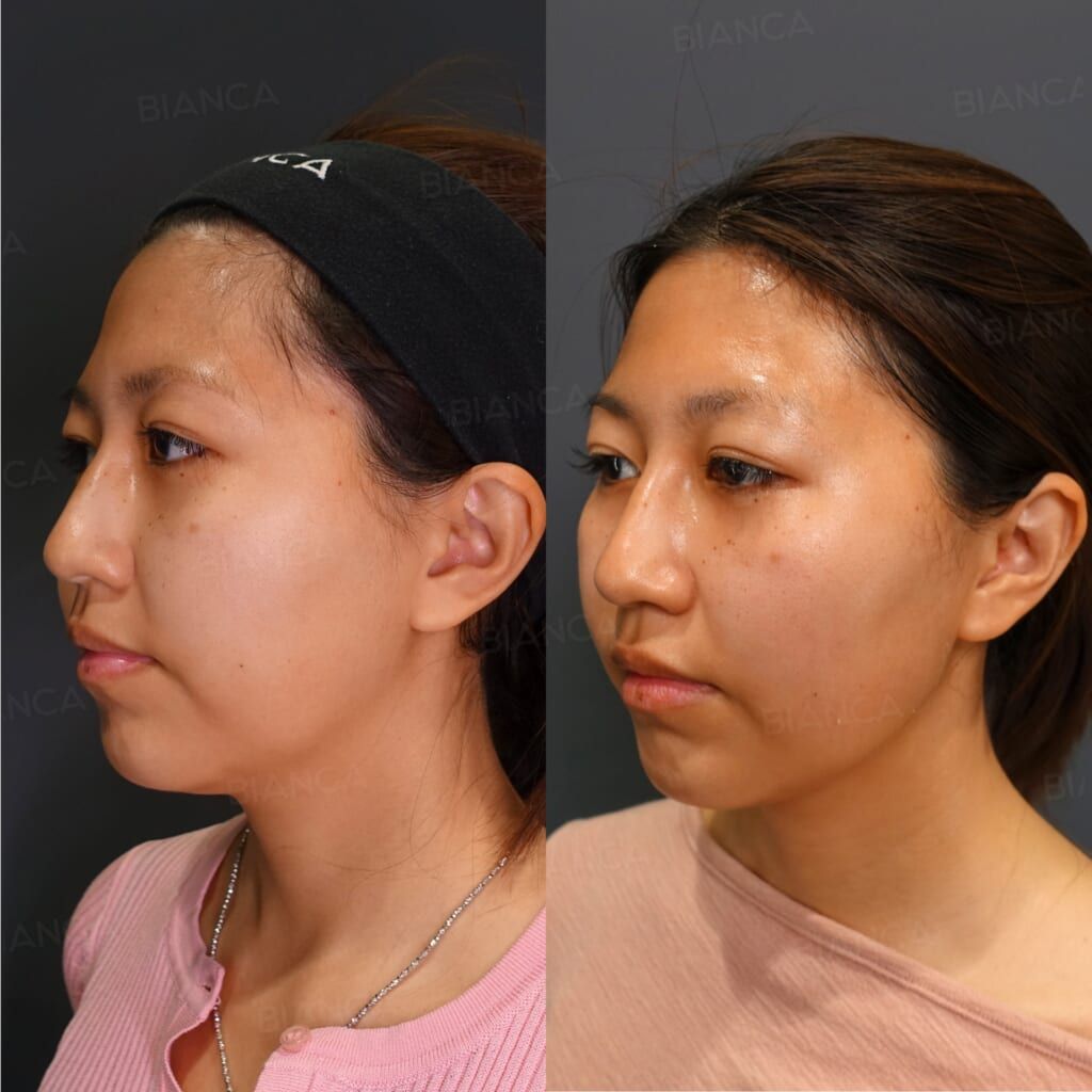 Alma PrimeX (Face)