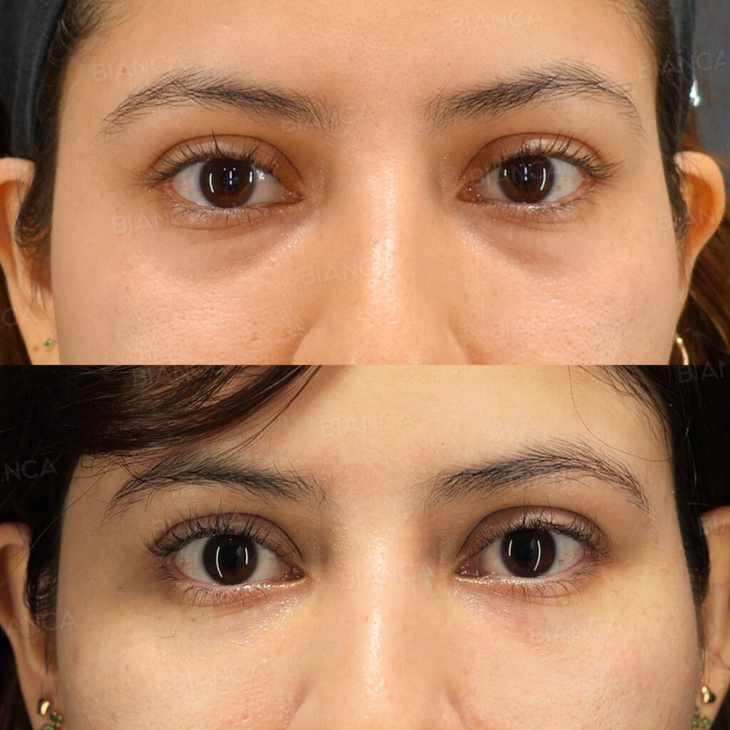Baby Collagen Injection (Under Eyes) before and after, 2 weeks, BIANCA CLINIC Tokyo