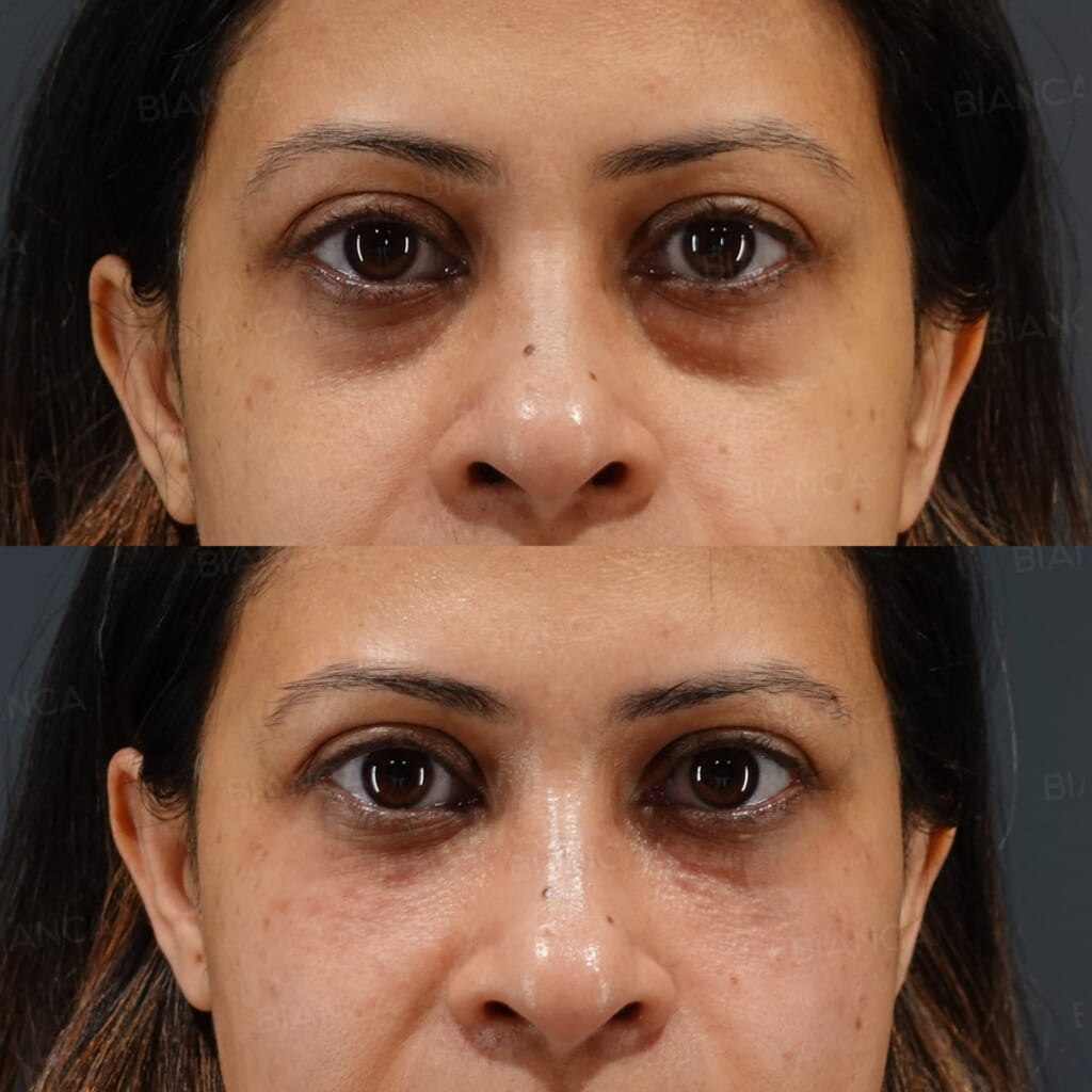 Baby Collagen Injection (Under Eyes) before and after, immediately after treatment, BIANCA CLINIC Tokyo