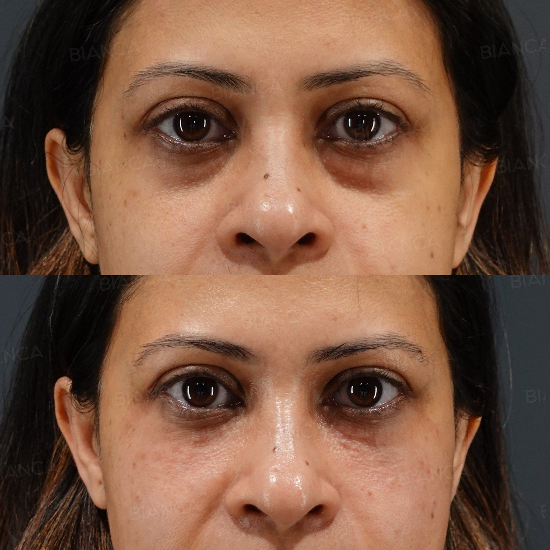 Baby Collagen Injection (Under Eyes) before and after, immediately after treatment, BIANCA CLINIC Tokyo