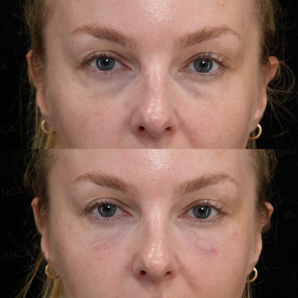 Baby Collagen Injection (Under Eyes) before and after, immediately after treatment, BIANCA CLINIC Tokyo