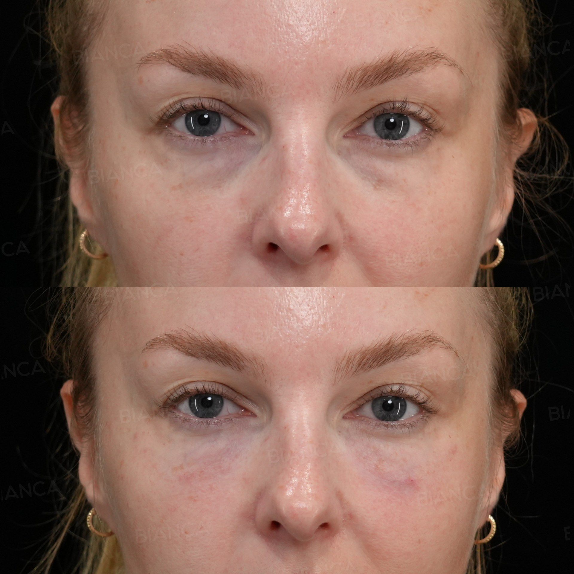 Baby Collagen Injection (Under Eyes) before and after, immediately after treatment, BIANCA CLINIC Tokyo