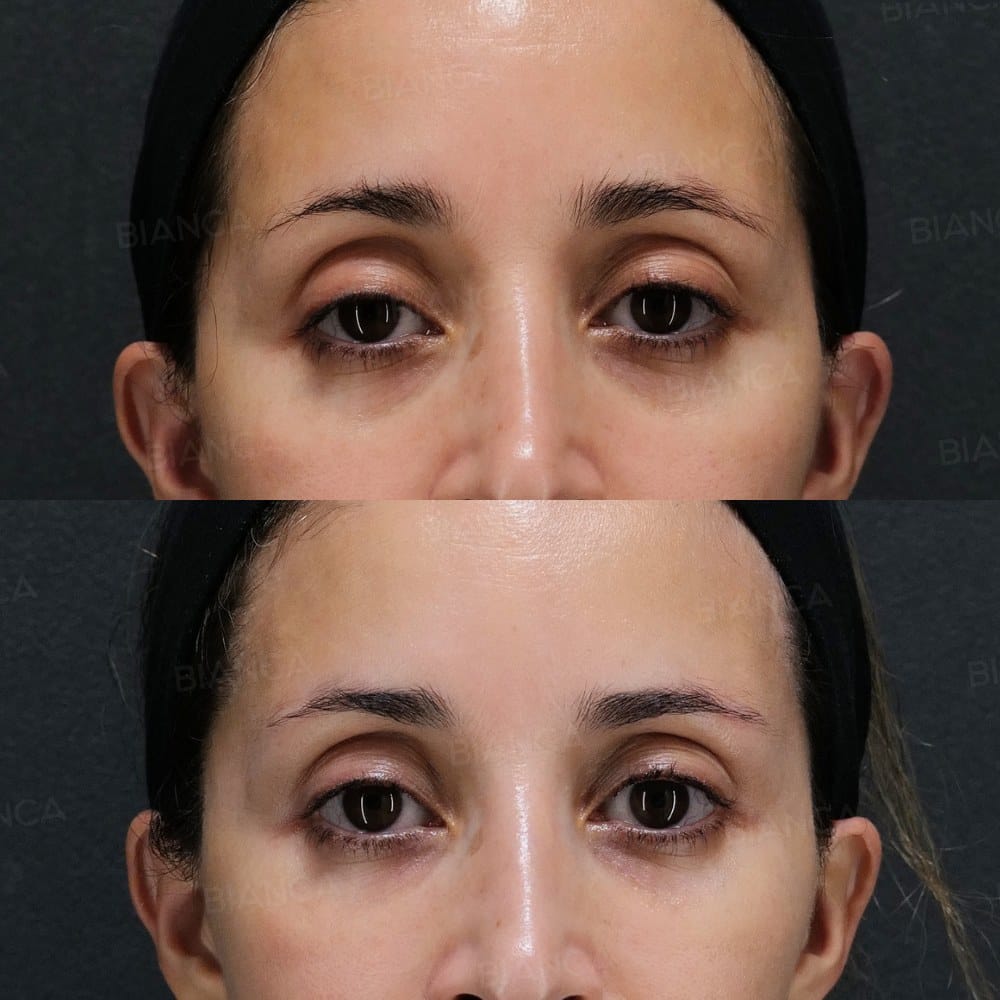 Baby Collagen Injection (Under Eyes) before and after, 2 weeks, BIANCA CLINIC Tokyo