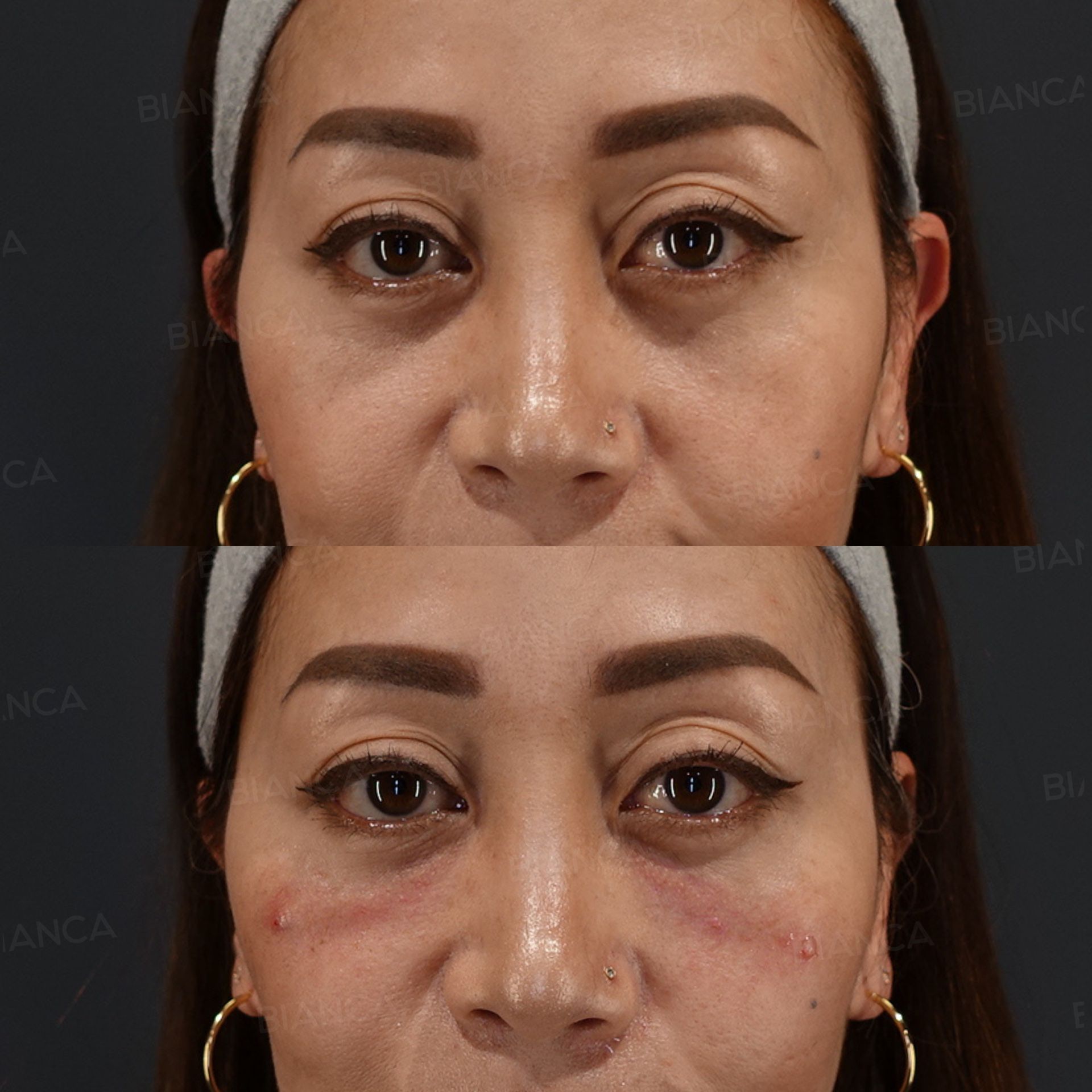 Baby collagen injection before and after restoring lost support in the hollow under the eyes, front view, immediately after treatment
