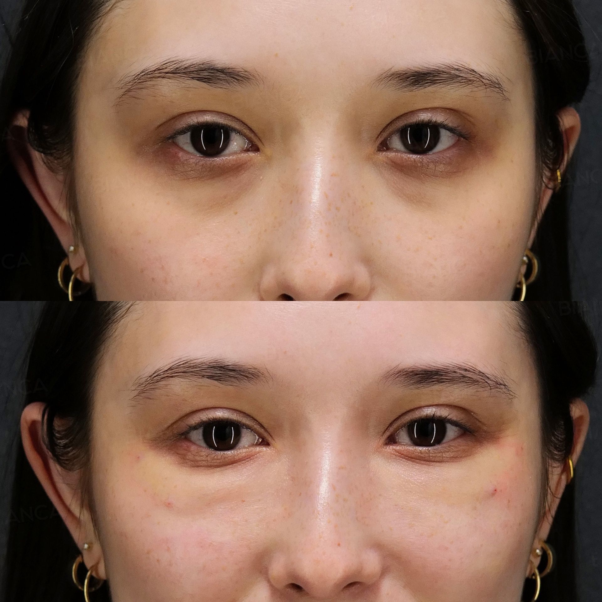 Baby collagen injection before and after cannula placement under the eyes, front view close-up of the eye area immediately after treatment