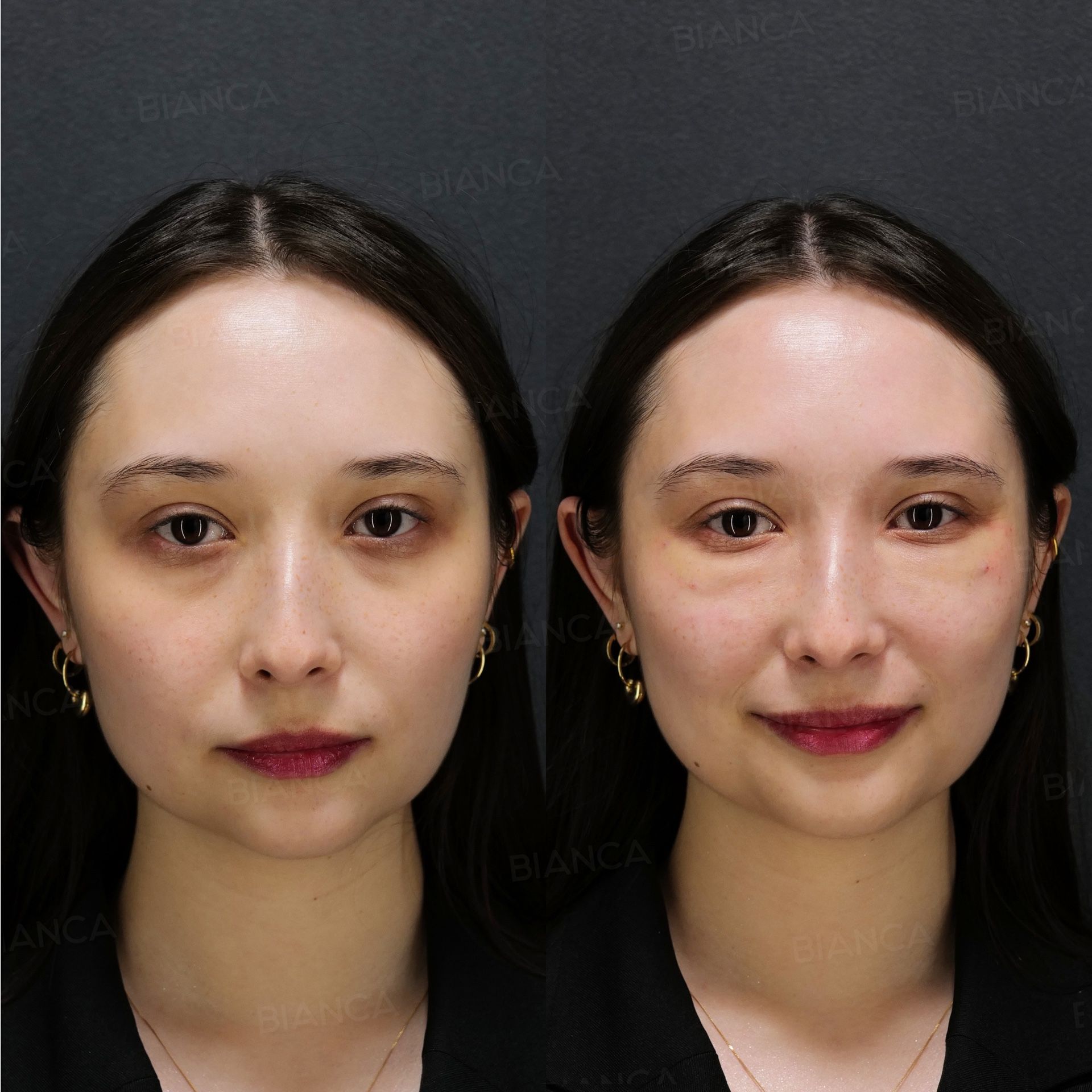 Baby collagen injection before and after cannula placement against the bone for an under eye depression, front view of the face immediately after treatment