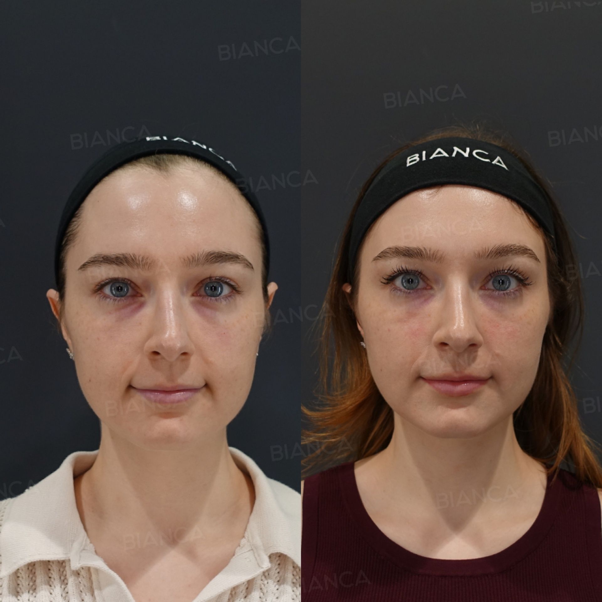 Baby collagen injection before and after treatment under the eyes, front view at 2 weeks