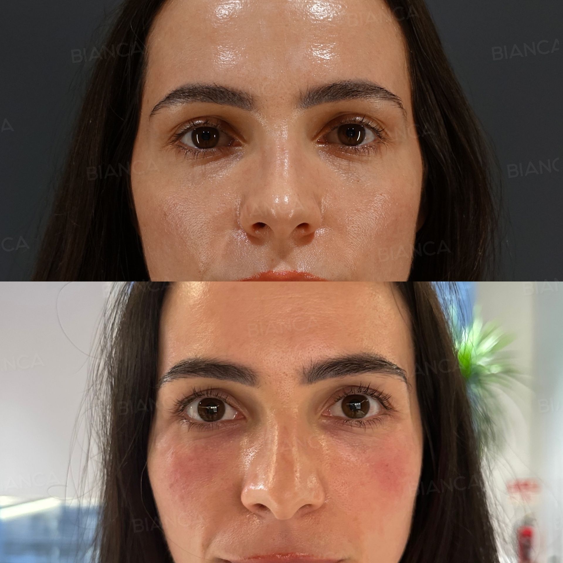 Baby collagen injection before and after treatment of the hollows under the eyes placed with a blunt cannula, front view, immediately after treatment