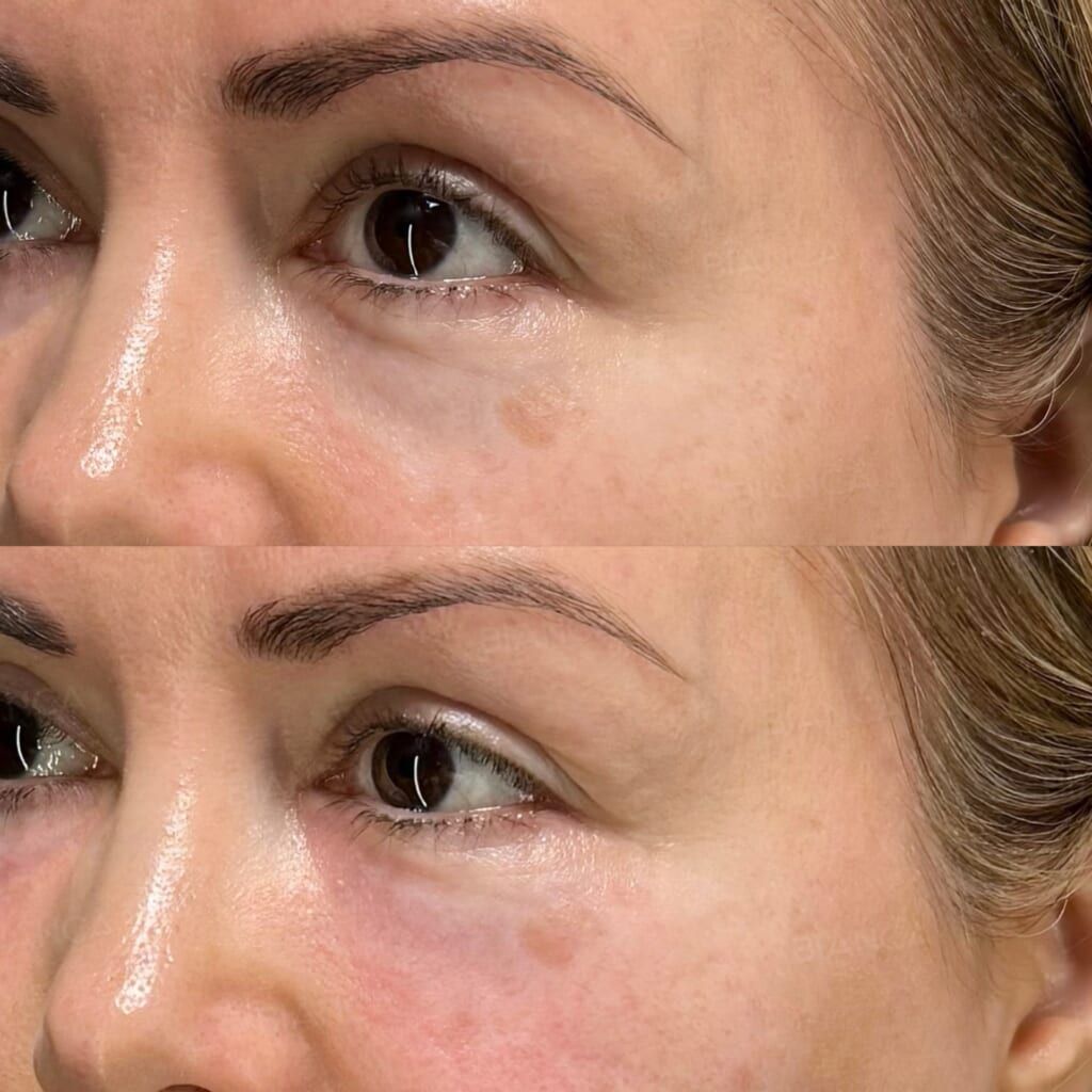 Baby Collagen (Under Eyes)