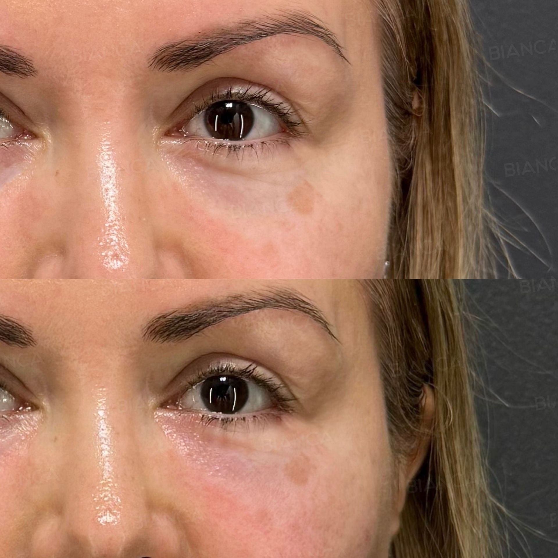 Baby collagen injection before and after treatment of a shallow hollow under the eyes without eyelid surgery, front view close-up of one eye and the brow