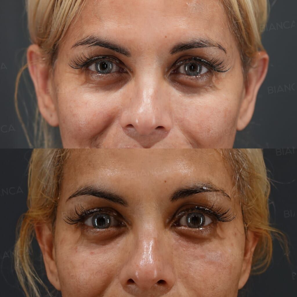 Baby Collagen (Under Eyes)
