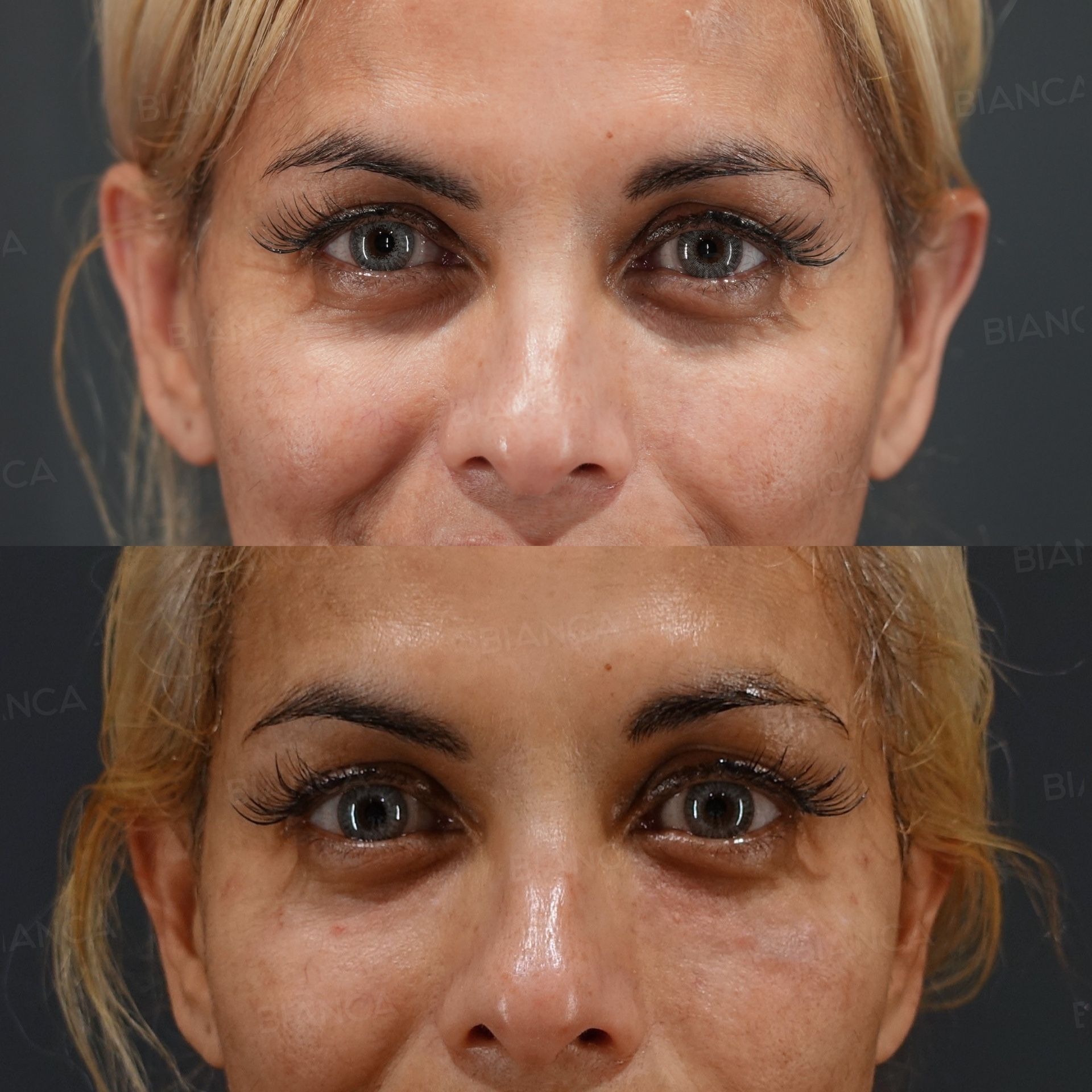 Baby Collagen (Under Eyes)