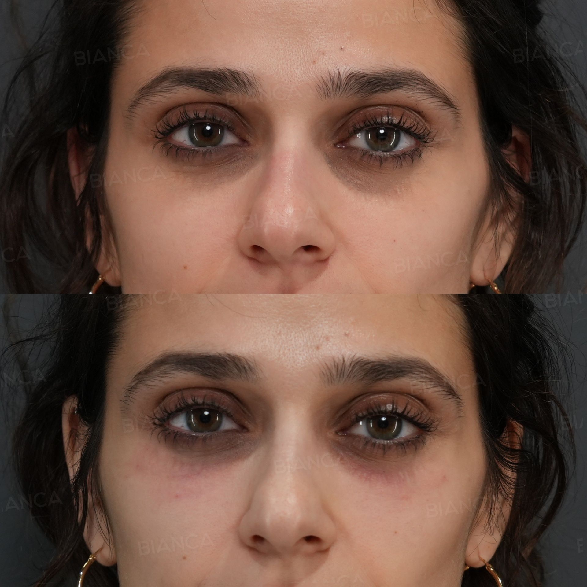 Baby Collagen (Under Eyes)