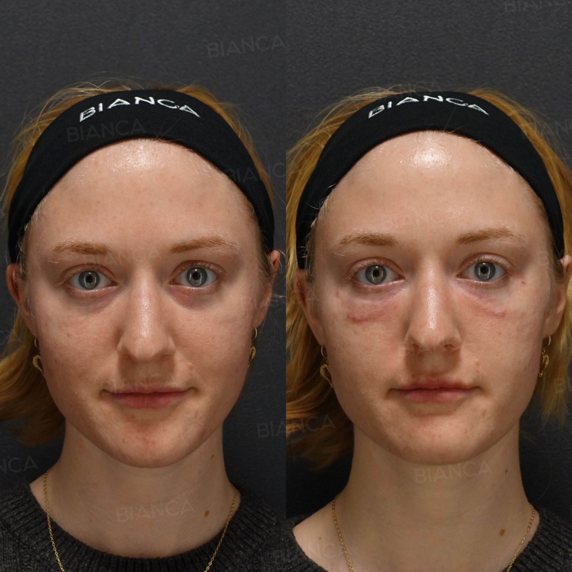 Baby collagen injection before and after replacing lost volume in the tear trough under the eyes, front view, immediately after treatment
