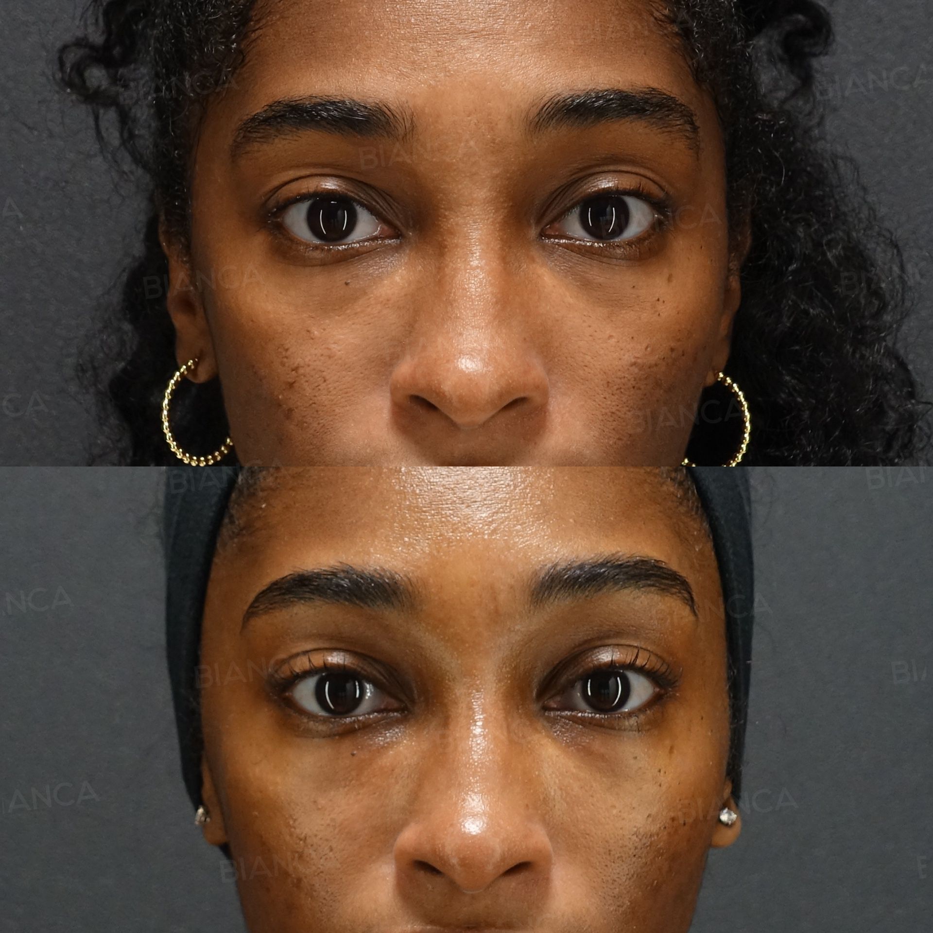 Baby collagen injection before and after filling the hollow under the lower eyelid, front view at 2 weeks