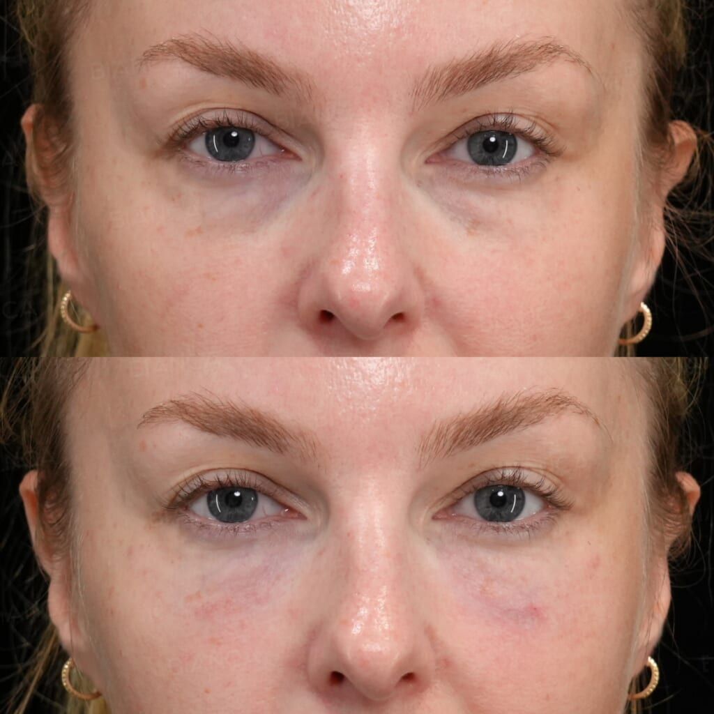 Baby Collagen (Under Eyes)