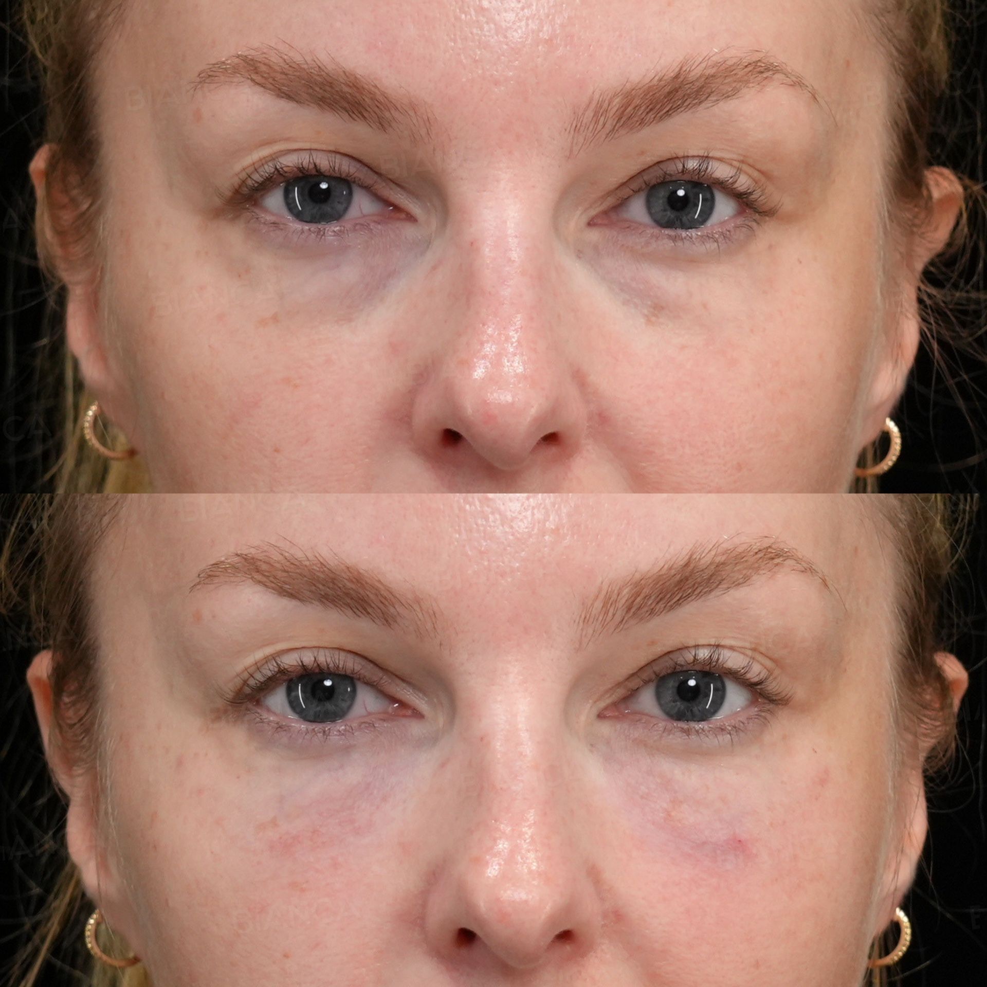Baby Collagen (Under Eyes)
