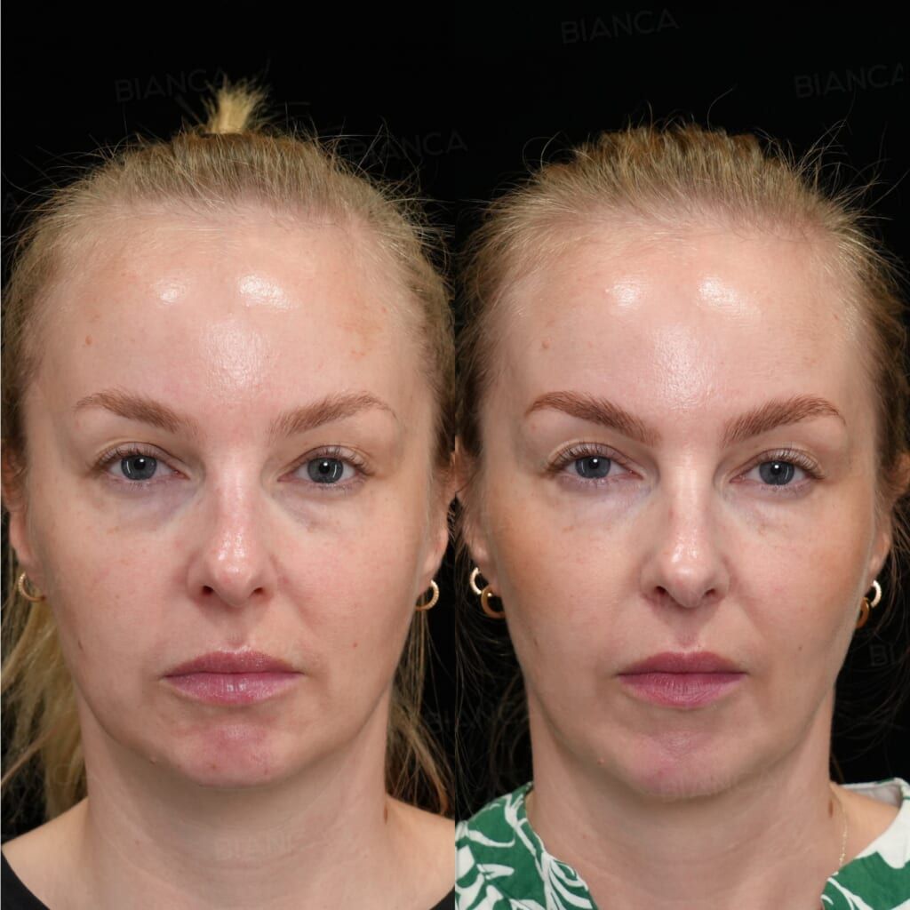 Baby Collagen (Under Eyes)