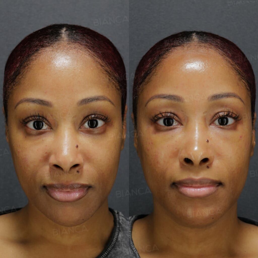 Baby Collagen (Under Eyes)