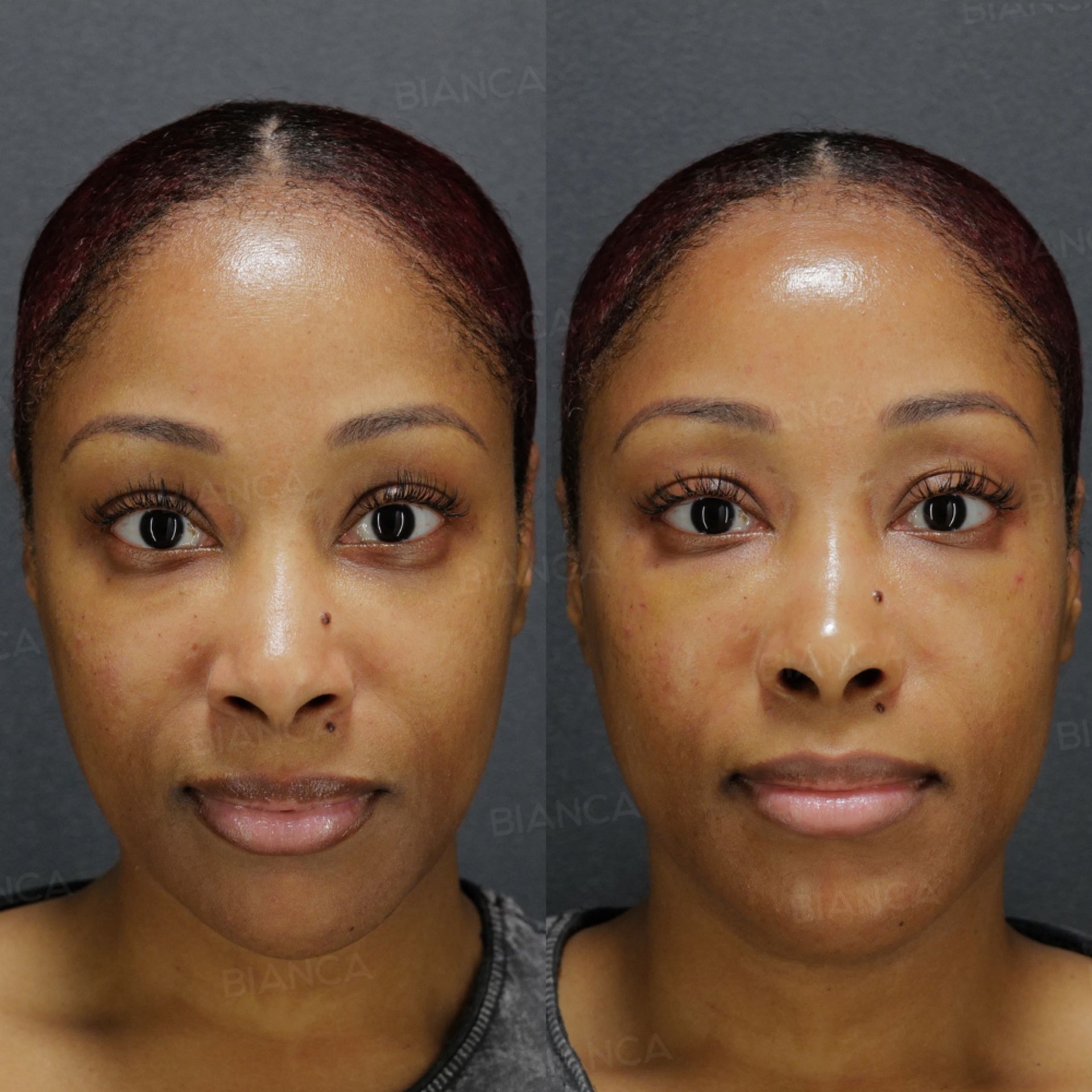 Baby Collagen (Under Eyes)