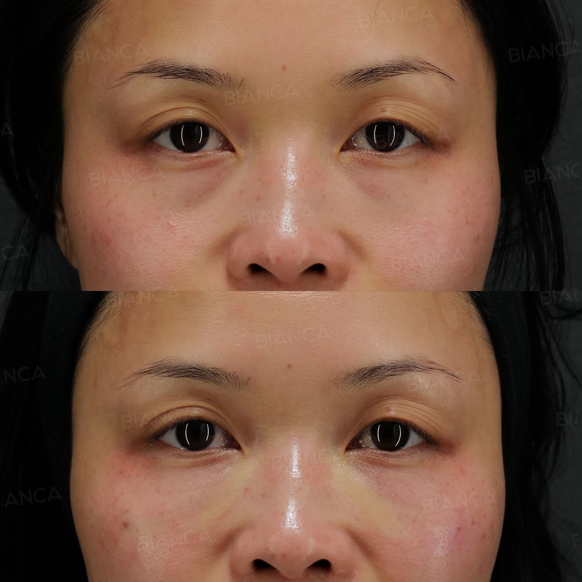 Baby collagen injection before and after treatment of fine crepe lines and a shallow depression on the lower lid, front view, immediately after treatment