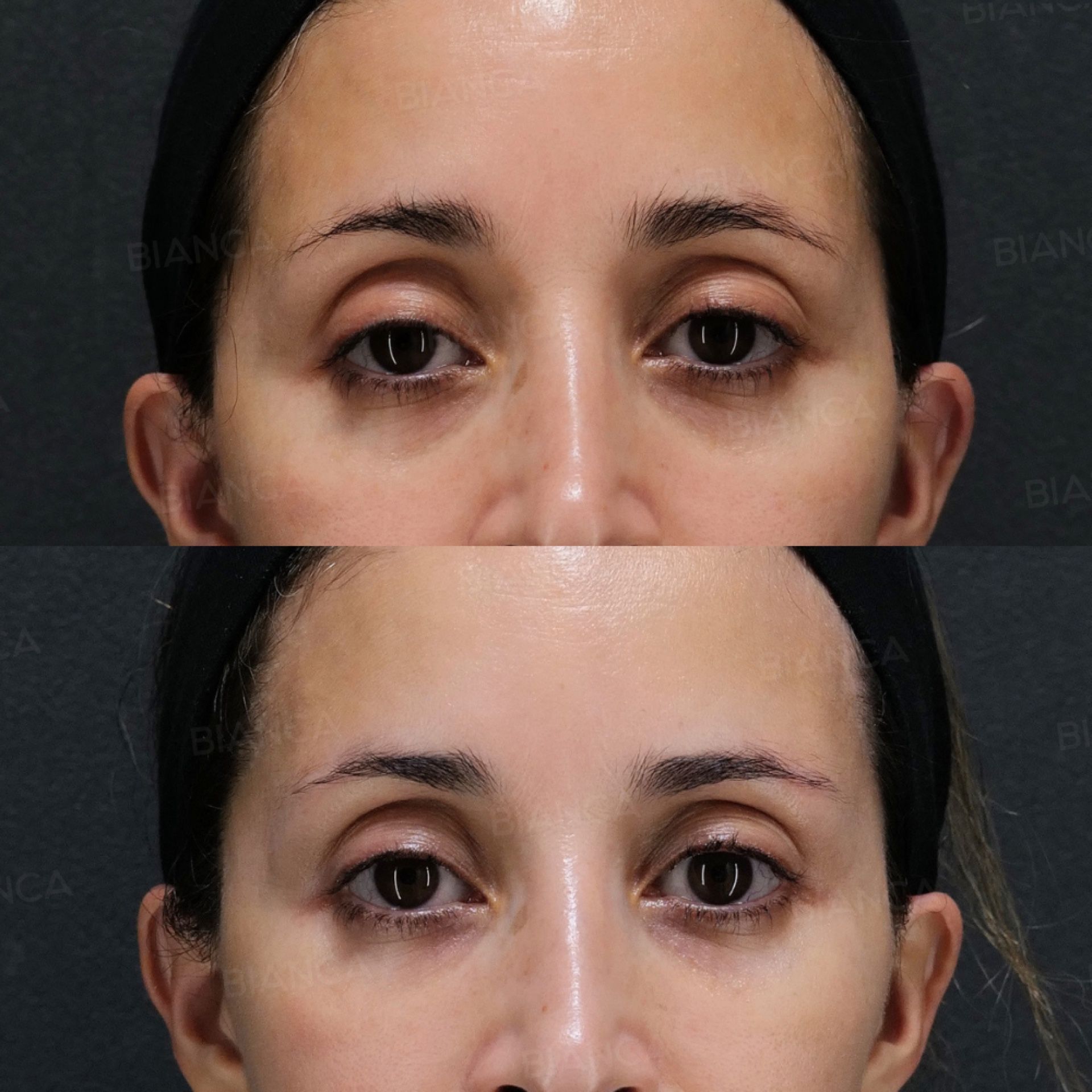 Baby Collagen (Under Eyes)